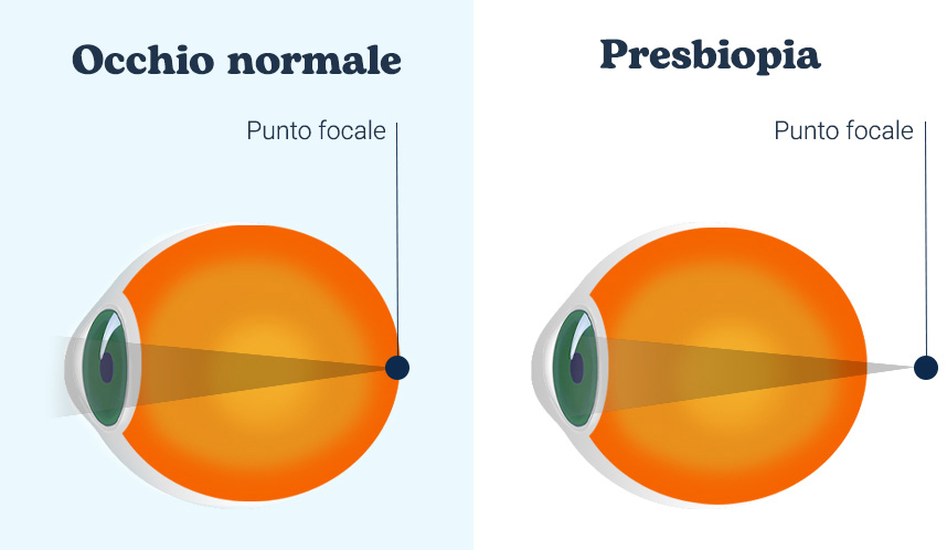 immagine anatomica del punto focale in un occhio normale e in un occhio affetto da presbiopia