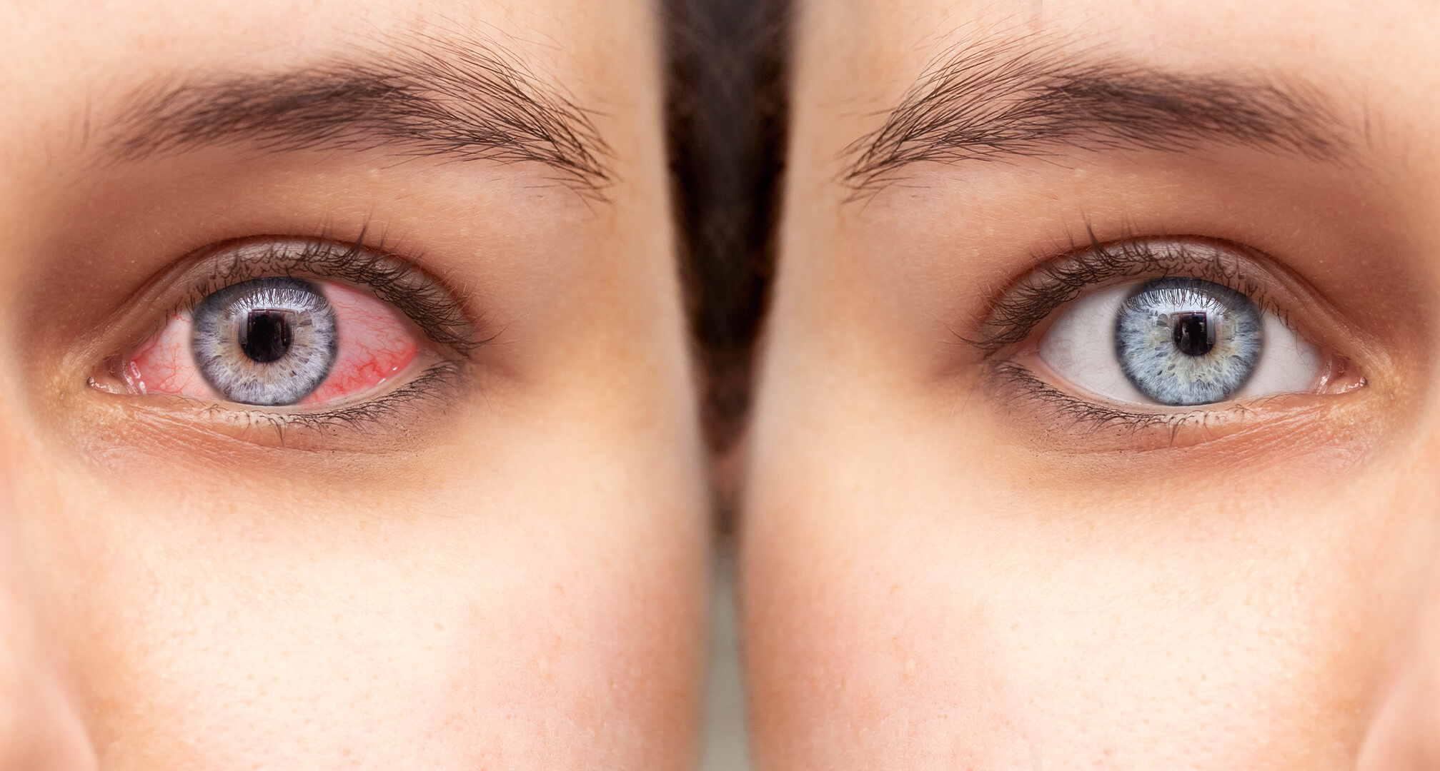 primo piano di due occhi affiancati, un occhio secco e rosso a sinistra e un occhio sano a destra