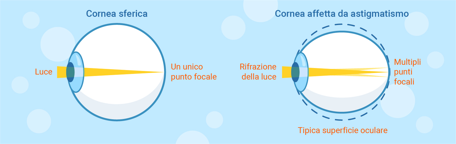 cornea normale e cornea astigmatica